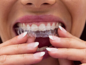 alinhadores transparentes