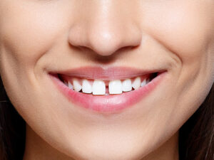 diastema