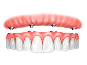 implantes dentários