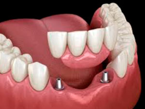 próteses dentárias